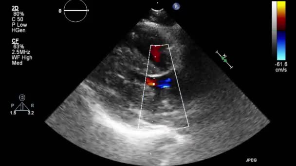 High Quality Video Ultrasound Transesophageal Examination Heart — Stock Video