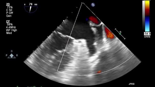 Ecografia Video Alta Qualità Esame Transesofageo Del Cuore — Video Stock