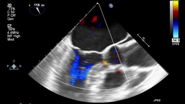 Examen Transesofágico Por Ultrasonido Video Alta Calidad Del Corazón — Vídeo de stock