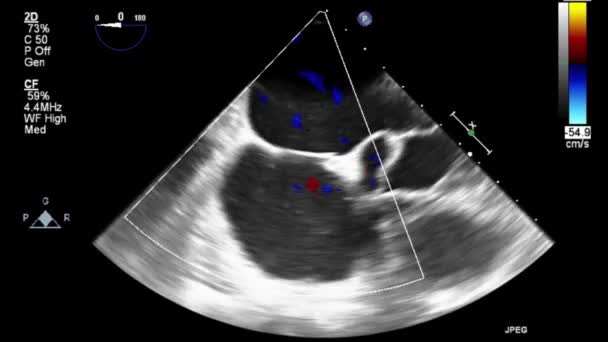 Examen Transesofágico Por Ultrasonido Video Alta Calidad Del Corazón — Vídeos de Stock