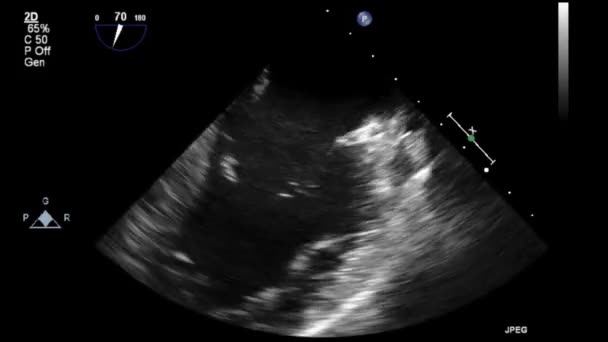 Examen Transesofágico Por Ultrasonido Video Alta Calidad Del Corazón — Vídeo de stock