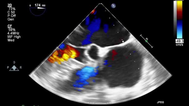 Kalbin Yüksek Kaliteli Ultrason Transsofageal Muayenesi — Stok video