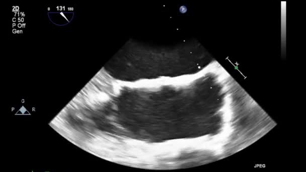 Качественное Видео Ультразвуковое Трансофагеальное Обследование Сердца — стоковое видео