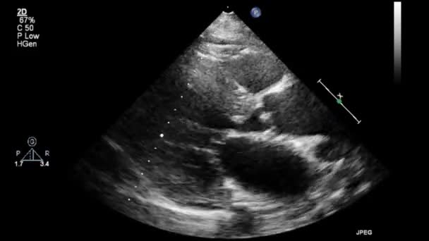 Examen Transesofágico Por Ultrasonido Video Alta Calidad Del Corazón — Vídeos de Stock