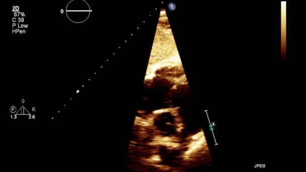 Hochwertige Video Ultraschall Transesophagealuntersuchung Des Herzens — Stockvideo