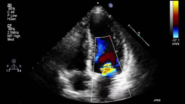 Kalbin Yüksek Kaliteli Ultrason Transsofageal Muayenesi — Stok video