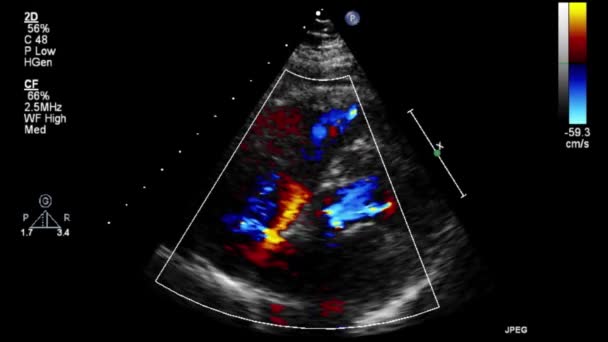 Examen Transesofágico Por Ultrasonido Video Alta Calidad Del Corazón — Vídeo de stock