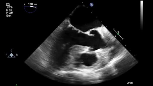 Examen Transesofágico Por Ultrasonido Video Alta Calidad Del Corazón — Vídeos de Stock