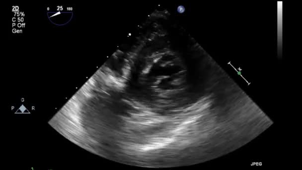 Examen Transesofágico Por Ultrasonido Video Alta Calidad Del Corazón — Vídeo de stock