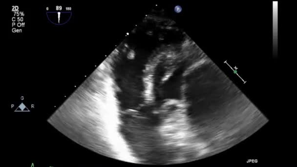 High Quality Video Ultrasound Transesophageal Examination Heart — Stock Video