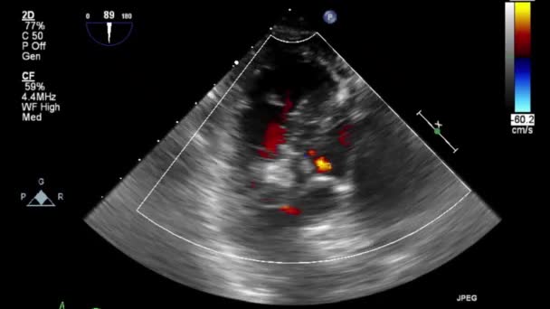 Wysokiej Jakości Wideo Usg Przełyku Badanie Serca — Wideo stockowe