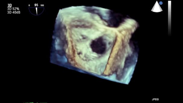 Hoge Kwaliteit Video Echografie Transslokdarmonderzoek Van Het Hart — Stockvideo