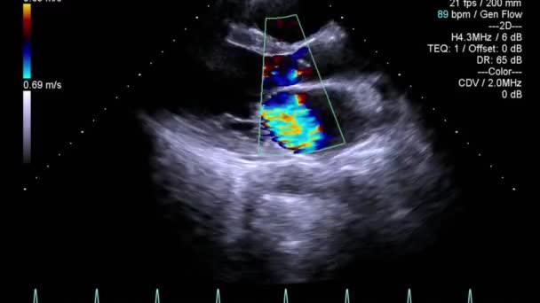 Качественное Видео Ультразвуковое Трансофагеальное Обследование Сердца — стоковое видео