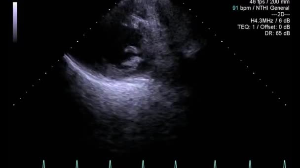 Usg Kualitas Tinggi Untuk Video Transesophageal Pemeriksaan Jantung — Stok Video