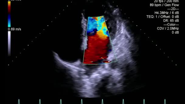 Examen Transesofágico Por Ultrasonido Video Alta Calidad Del Corazón — Vídeo de stock