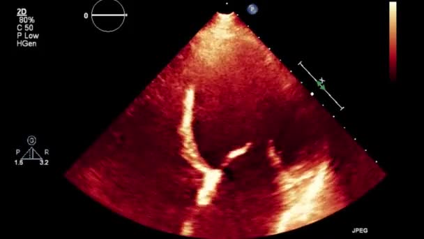 Examen Transesofágico Por Ultrasonido Video Alta Calidad Del Corazón — Vídeo de stock