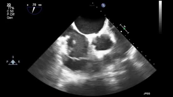 Høj Kvalitet Video Ultralyd Transesophageal Undersøgelse Hjertet – Stock-video