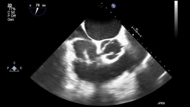 Качественное Видео Ультразвуковое Трансофагеальное Обследование Сердца — стоковое видео