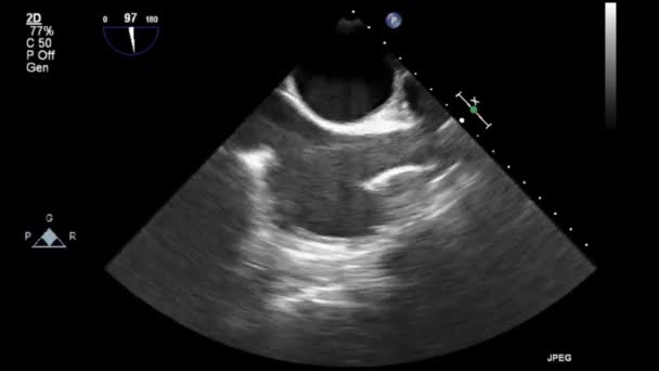 Hochwertige Video Ultraschall Transesophagealuntersuchung Des Herzens — Stockvideo