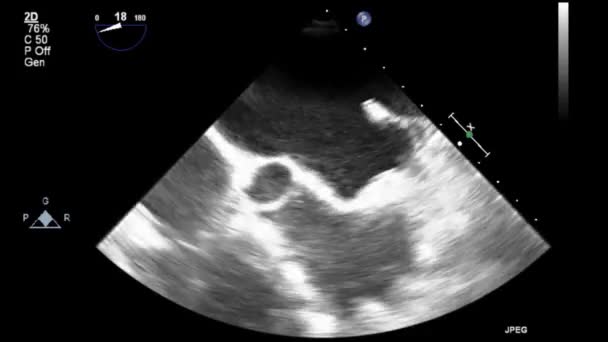 Examen Transesofágico Por Ultrasonido Video Alta Calidad Del Corazón — Vídeo de stock