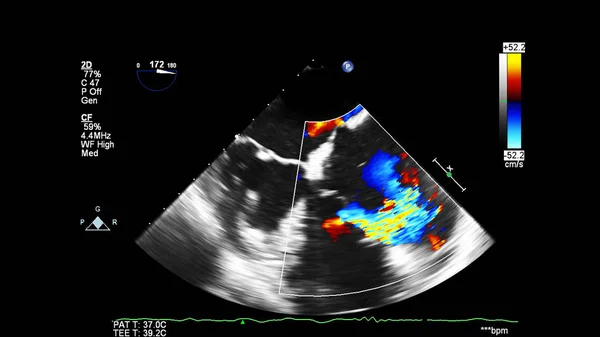 Immagine Del Cuore Durante Ecografia Transesofagea Con Modalità Doppler — Foto Stock