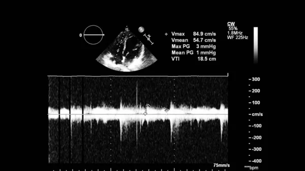 Transesofageal Ultrason Sırasında Kalbin Gri Ölçekli Görüntüsü — Stok fotoğraf