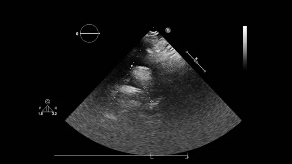Abbildung Des Herzens Graustufen Modus Während Des Transesophagealen Ultraschalls — Stockfoto