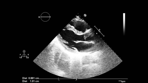 Image of the heart in gray-scale mode during transesophageal ultrasound.