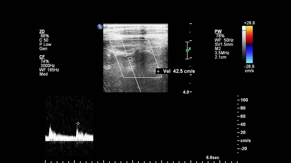 Pulse Wave Doppler Ultrasound Examination Vessels — Stok fotoğraf