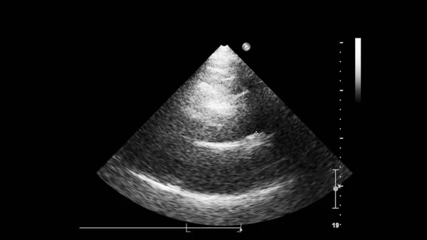 Transesofageal Ultrason Sırasında Kalbin Gri Ölçekli Görüntüsü — Stok fotoğraf