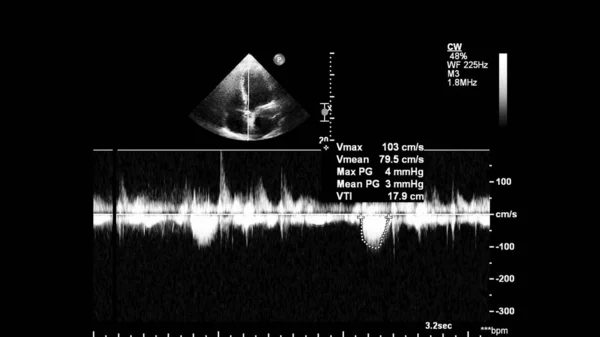 Image of the heart in gray-scale mode during transesophageal ultrasound.