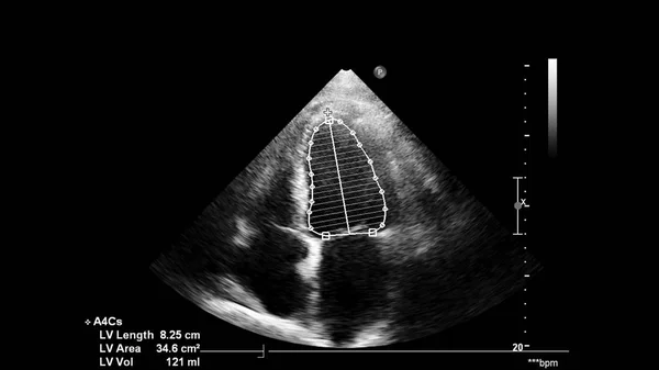 Image Heart Gray Scale Mode Transesophageal Ultrasound — Stock Photo, Image