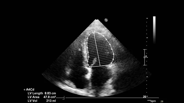 Bild Hjärtat Gråskala Transesofagalt Ultraljud — Stockfoto