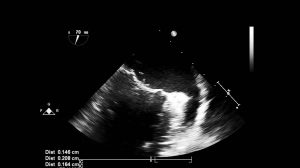 経食道超音波検査時のグレースケールモードで心臓の画像 — ストック写真