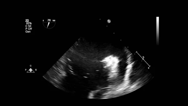 Abbildung Des Herzens Graustufen Modus Während Des Transesophagealen Ultraschalls — Stockfoto