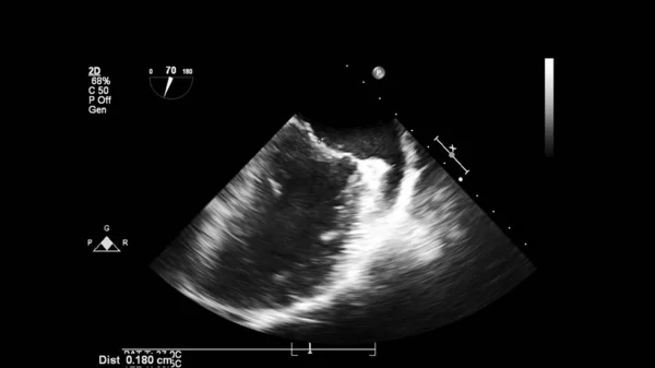 Afbeelding Van Het Hart Grijs Schaal Modus Tijdens Transesofageale Echografie — Stockfoto