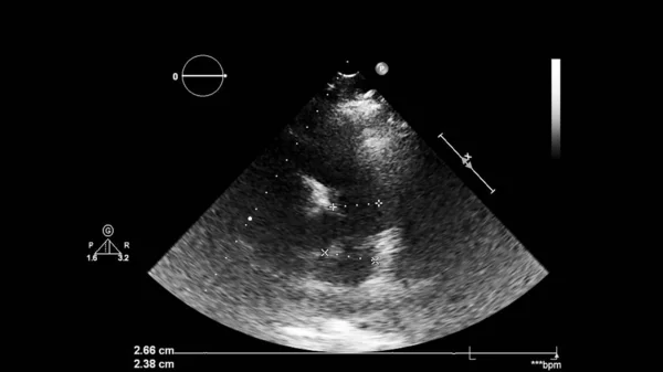 Transesofageal Ultrason Sırasında Kalbin Gri Ölçekli Görüntüsü — Stok fotoğraf