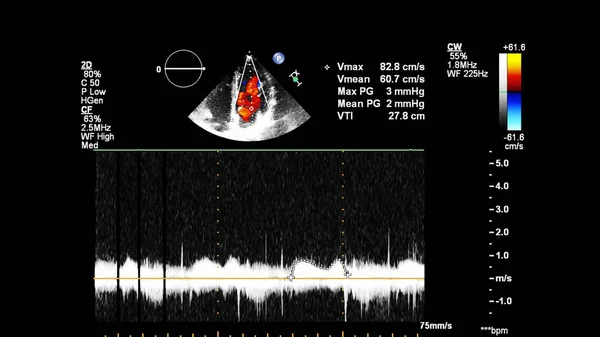 Transesofageal Ultrason Sırasında Doppler Kipi Ile Kalbin Görüntüsü — Stok fotoğraf