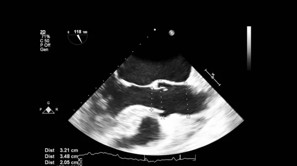 Image Heart Gray Scale Mode Transesophageal Ultrasound — Stock Photo, Image