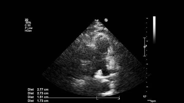 Transesofageal Ultrason Sırasında Kalbin Gri Ölçekli Görüntüsü — Stok fotoğraf