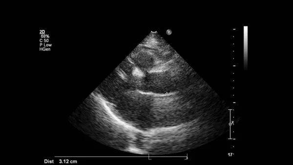 Obrázek Srdce Šedém Měřítku Během Transesofageálního Ultrazvuku — Stock fotografie