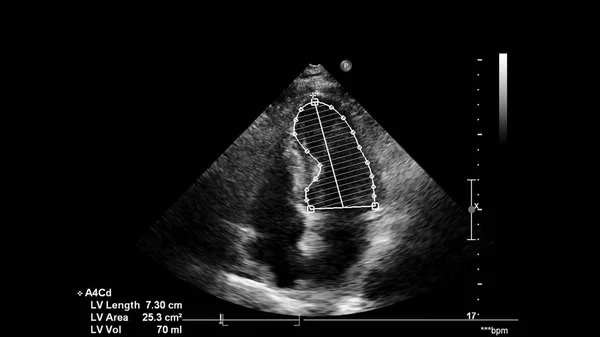 Transesofageal Ultrason Sırasında Kalbin Gri Ölçekli Görüntüsü — Stok fotoğraf