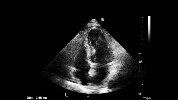 Kép Szív Szürke Skála Mód Során Transesophagealis Ultrahang — Stock Fotó