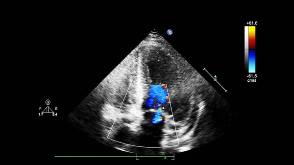 Transesofageal Ultrason Sırasında Doppler Kipi Ile Kalbin Görüntüsü — Stok fotoğraf