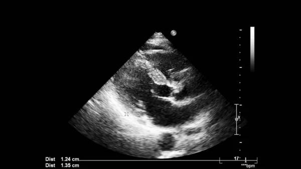 Transesofageal Ultrason Sırasında Kalbin Gri Ölçekli Görüntüsü — Stok fotoğraf