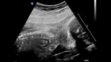 Fetal kalbin ultrason muayenesi.