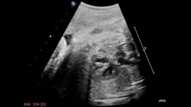 Fetal kalbin ultrason muayenesi.