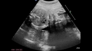 Fetal kalbin ultrason muayenesi.