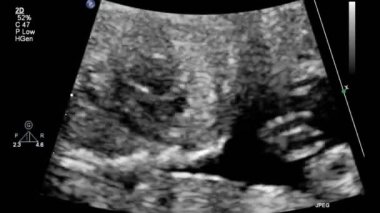 Fetal kalbin ultrason muayenesi.