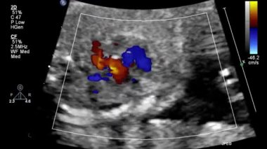 Fetal kalbin ultrason muayenesi.